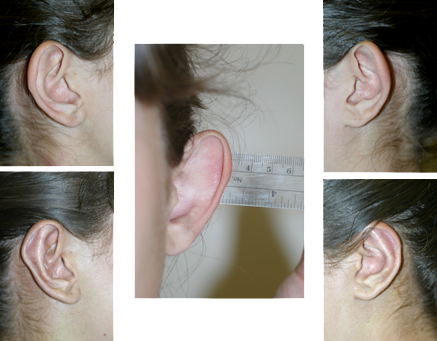 Otoplasty (Ear Surgery) Before & After