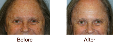 Skin Rejuvenation Before & After Case