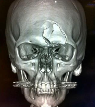 trauma-to-frontal-forehead-bone