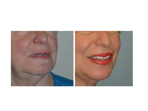 All-on-4® treatment concept case Before & After