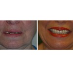 All-on-4® treatment concept case Before & After