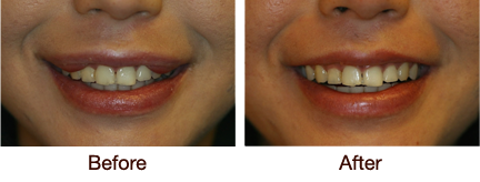 Before & After Lip Enhancement
