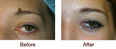 Mole Removal from Eyebrow - Before & After Photo