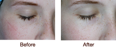 Mole Removal - Before & After Photo
