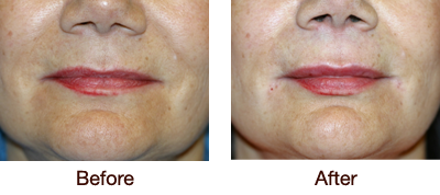 Before & After - Upper Lip Enhancement