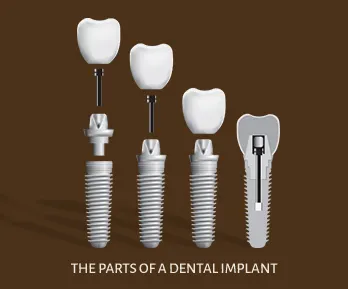 the parts of a dental implant