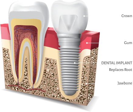 dental implant illustration showing crown, gum, dental implant, and jawbone