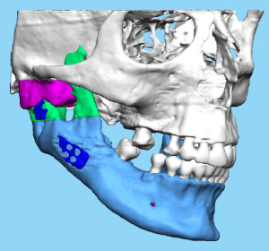 Ankylosis of mandible and exuberant bone to cranial base