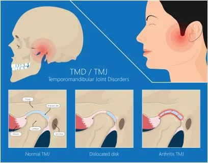 TMD | Arthroplasty Surgery illustration