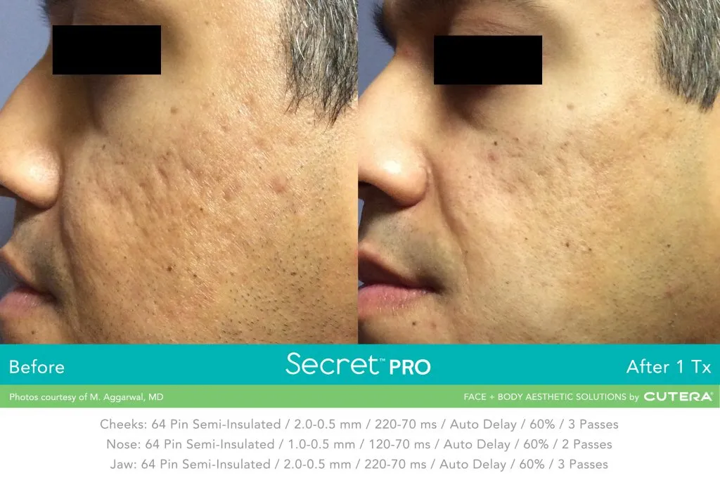 Secret Pro before and after 