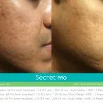 Secret Pro before and after 